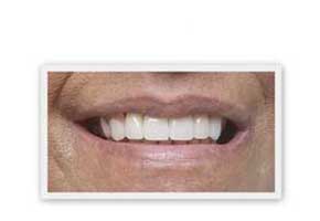 The image shows a close-up of a person s smiling mouth with teeth, set against a white background.