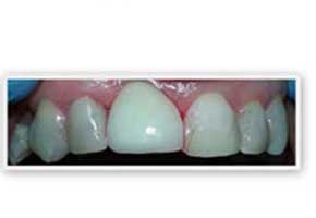 The image displays a close-up of a person s teeth, showcasing a professional dental cleaning with visible plaque removal and polishing.