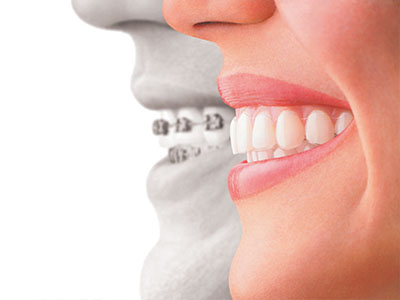 Image of a smiling person with an overlaid transparent representation of a dental implant.