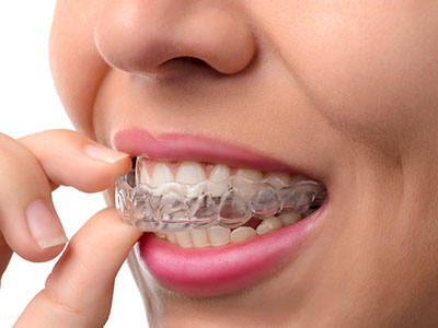 The image shows a person with a clear dental retainer in their mouth, holding it between their fingers.