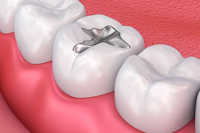 The image depicts a close-up view of a human tooth with an implanted dental implant.