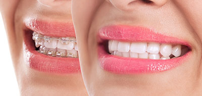 An image of a person smiling, with two overlapping photos showing their teeth and lips.