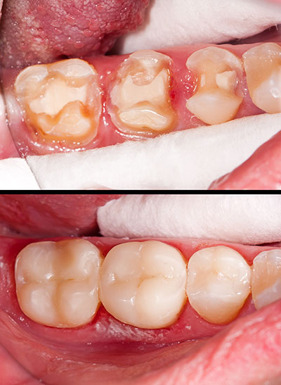 The image displays a close-up of a person s mouth with advanced dental decay, showing multiple teeth in need of repair or extraction.