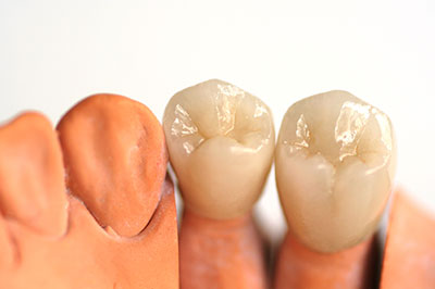 The image shows a set of artificial teeth with visible roots, placed side by side against a white background.