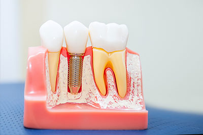 The image shows a close-up of a dental model with multiple teeth, some of which have fillings and are held together by a screw.