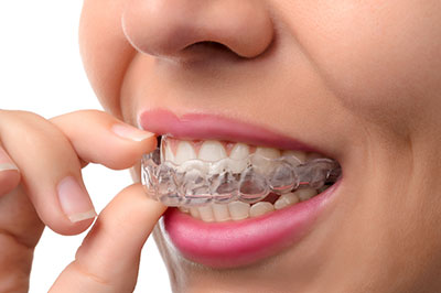 A person with a smile showing their braces, holding a toothpick in their mouth.