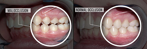 The image shows a side-by-side comparison of a person s teeth before and after what appears to be orthodontic treatment, with the top half labeled  malocclusion  and the bottom half labeled  normal occlusion.