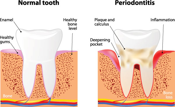 The image is a medical illustration showing the stages of tooth decay, from normal to periodontitis, with annotations indicating healthy tooth enamel, bone loss, and deepening pockets.