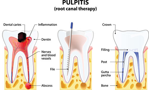 The image is a medical illustration showing the internal structure of a tooth, including the root canal therapy process, with labels indicating various parts such as dental caries, crown, filling, and gum tissue.