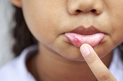 A young child with a pimple on their face, holding up a finger to touch the blemish.