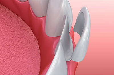 The image shows a close-up view of a dental implant with an attached abutment, set against a pink background that resembles gum tissue.