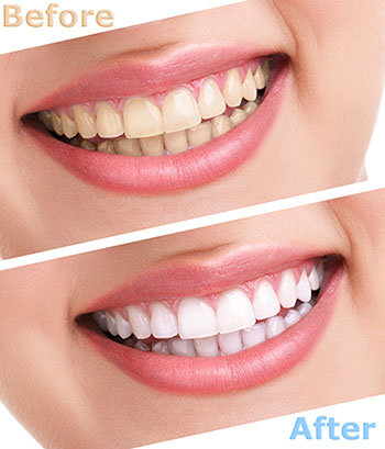 The image is a before-and-after advertisement for teeth whitening, showcasing the results of the treatment with two sets of images side by side.